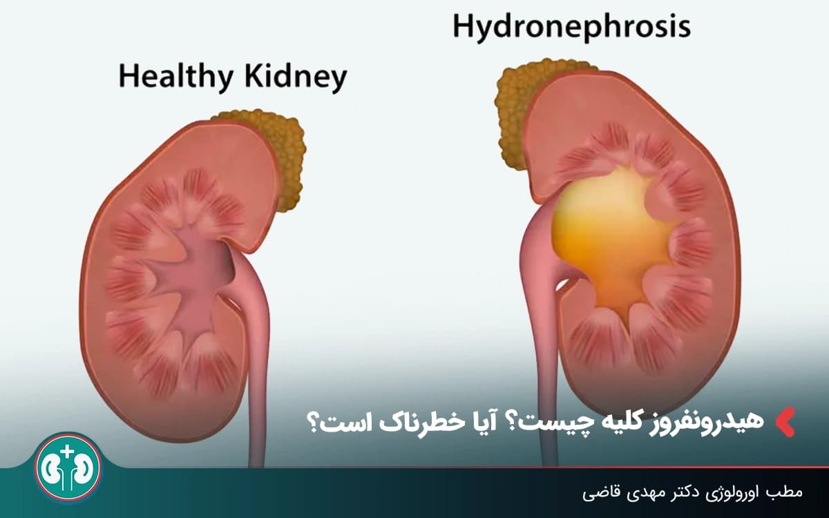 هیدرونفروز کلیه چیست؟ آیا خطرناک است؟ (تشخیص و درمان)