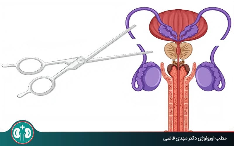 هل يمكن حدوث حمل بعد قطع القناة المنوية؟
