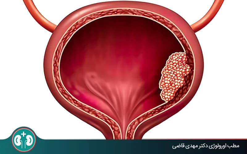 هل يمكن الشفاء التام من سرطان المثانة؟ فرص التعافي