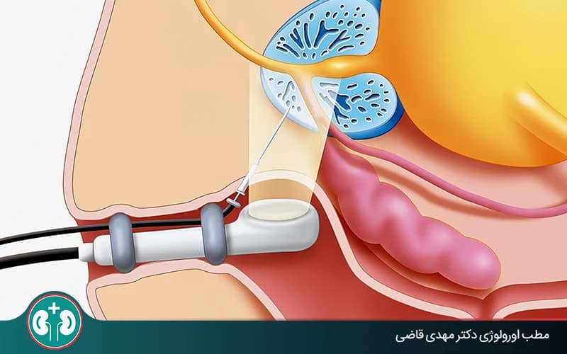 خطرات و عوارض بیوپسی پروستات؛ راهنمای جامع مراقبت بعد از آزمایش