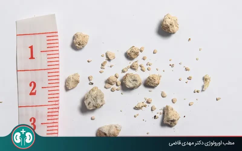 دفع سنگ کلیه ۴ تا ۱۰ میلیمتری و روش‌های دفع یا درمان آن