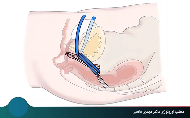 جراحة هبوط المثانة: الإصلاح بالمنظار أو عبر المهبل أو بالجراحة المفتوحة
