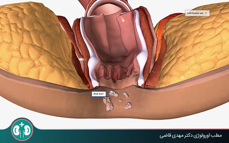 علائم زگیل تناسلی مقعدی در زنان + عکس، علائم، تشخیص و درمان