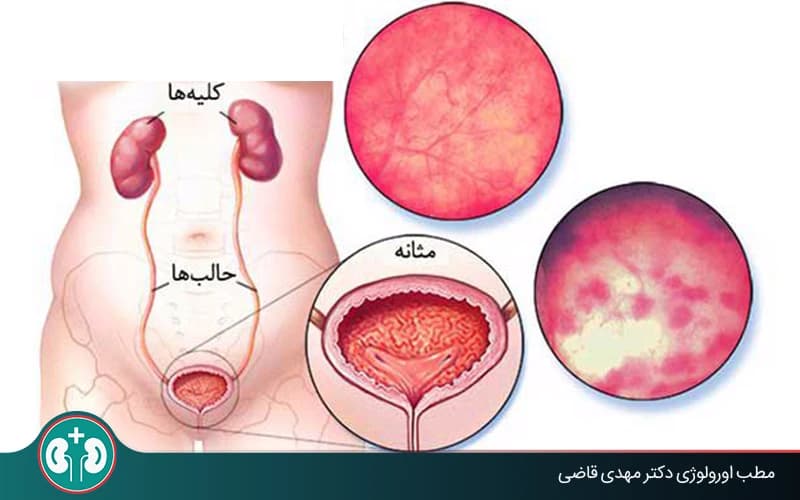 علاج التهاب المثانة أو السيستيت عند الرجال والنساء
