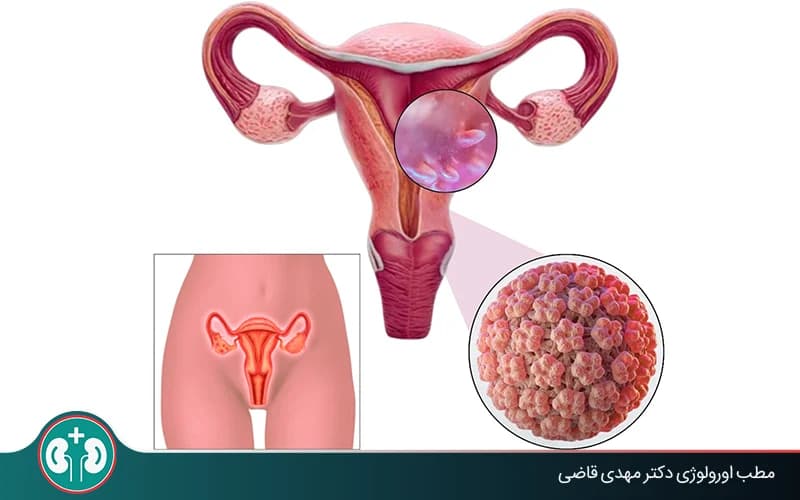 الثآليل التناسلية عالية الخطورة أو «الخبيثة»: الأعراض والتشخيص والعلاج