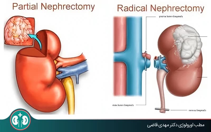 نفرکتومی چیست؟ جراحی برداشتن کلیه (پارشیال و رادیکال)