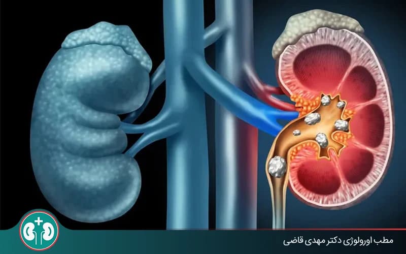 سنگ کلیه در حالب چگونه دفع می‌شود؟