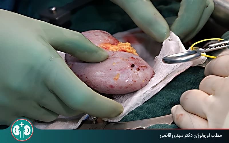زراعة الكلى: التكلفة وتوافق فصيلة الدم وطريقة الجراحة