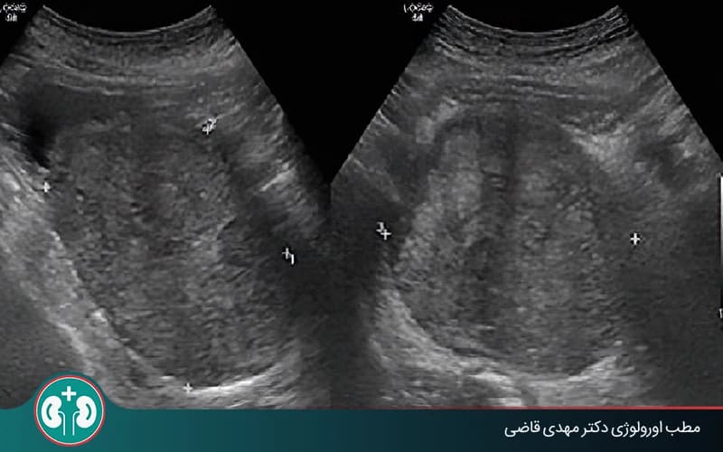 سونوگرافی پروستات؛ روش‌های انجام + تفسیر