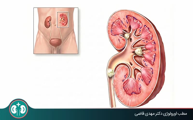 Can Kidney Stones Cause Kidney Failure?