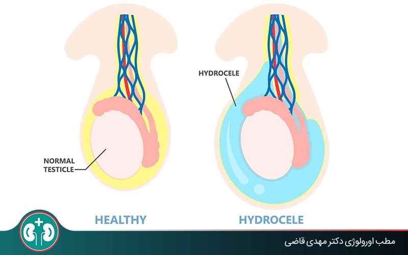 علت بزرگ شدن یکی از بیضه ها چیست؟