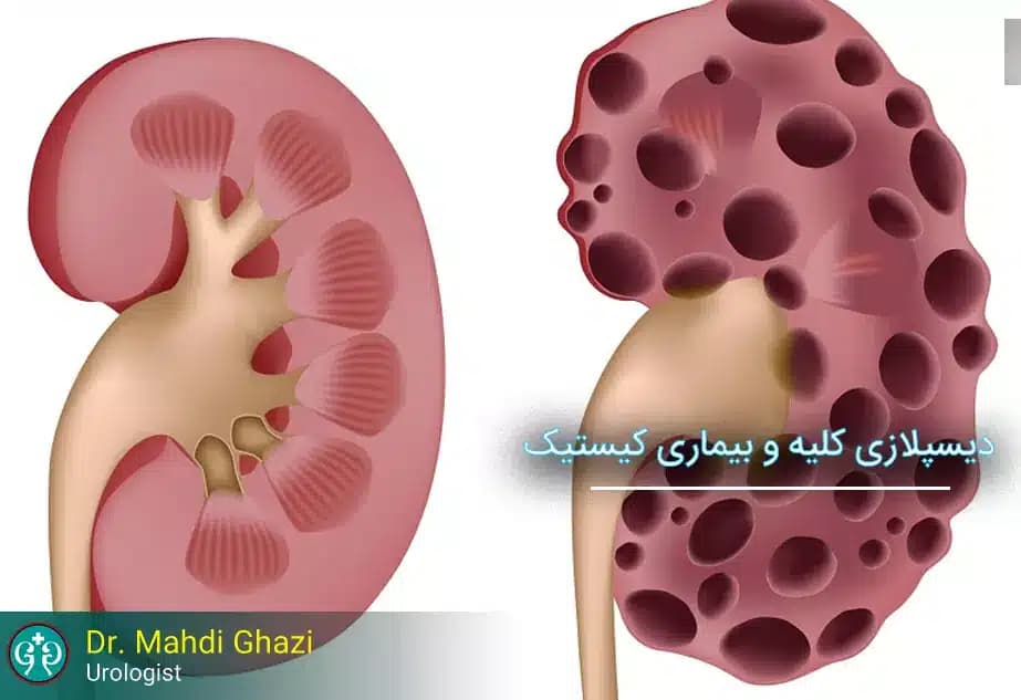 Cystic Kidney Diseases and Renal Dysplasia: Symptoms, Diagnosis, and Treatment