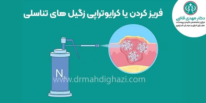 فریز کردن یا کرایوتراپی زگیل های تناسلی