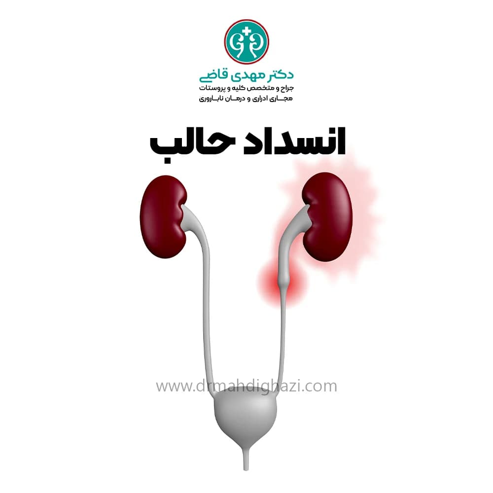 دکتر قاضی- بسته شدن حالب
