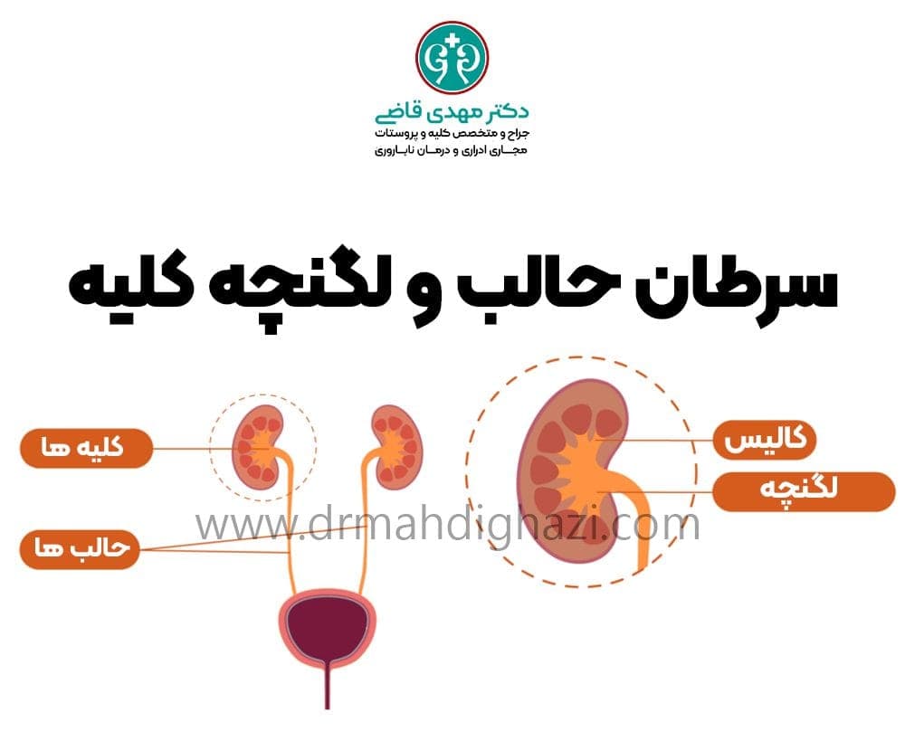 دکتر قاضی-سرطان حالب و لگنچه کلیه: علائم، تشخیص و درمان