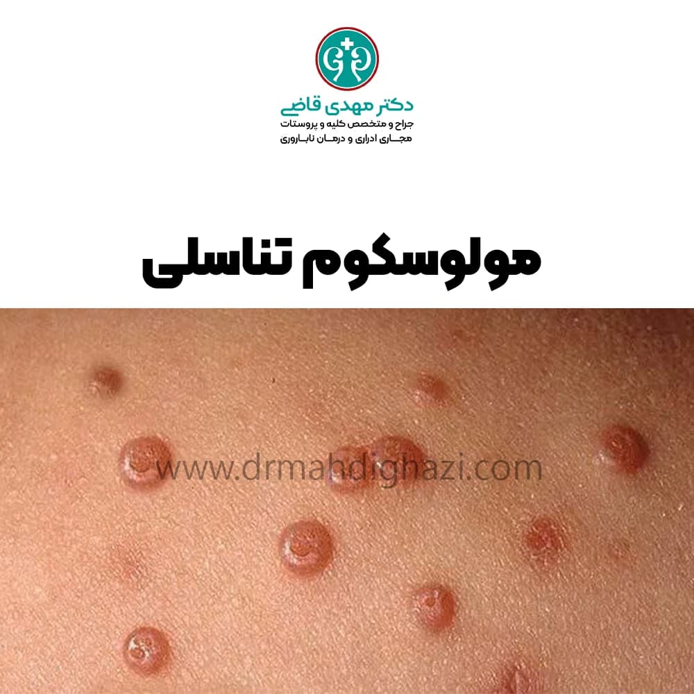 دکتر قاضی- مولوسکوم تناسلی