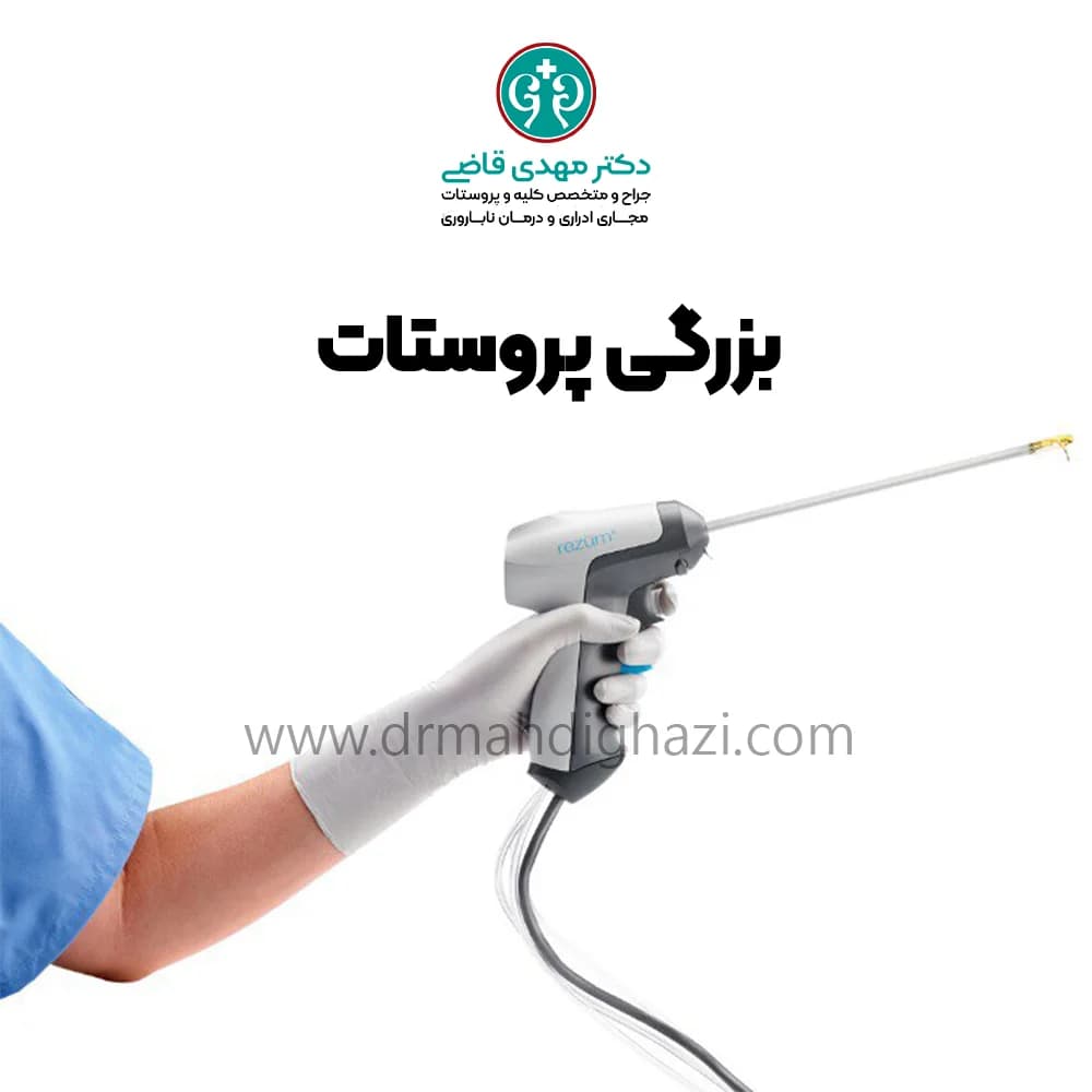 دکتر قاضی-هایپرپلازی خوش خیم پروستات BPH