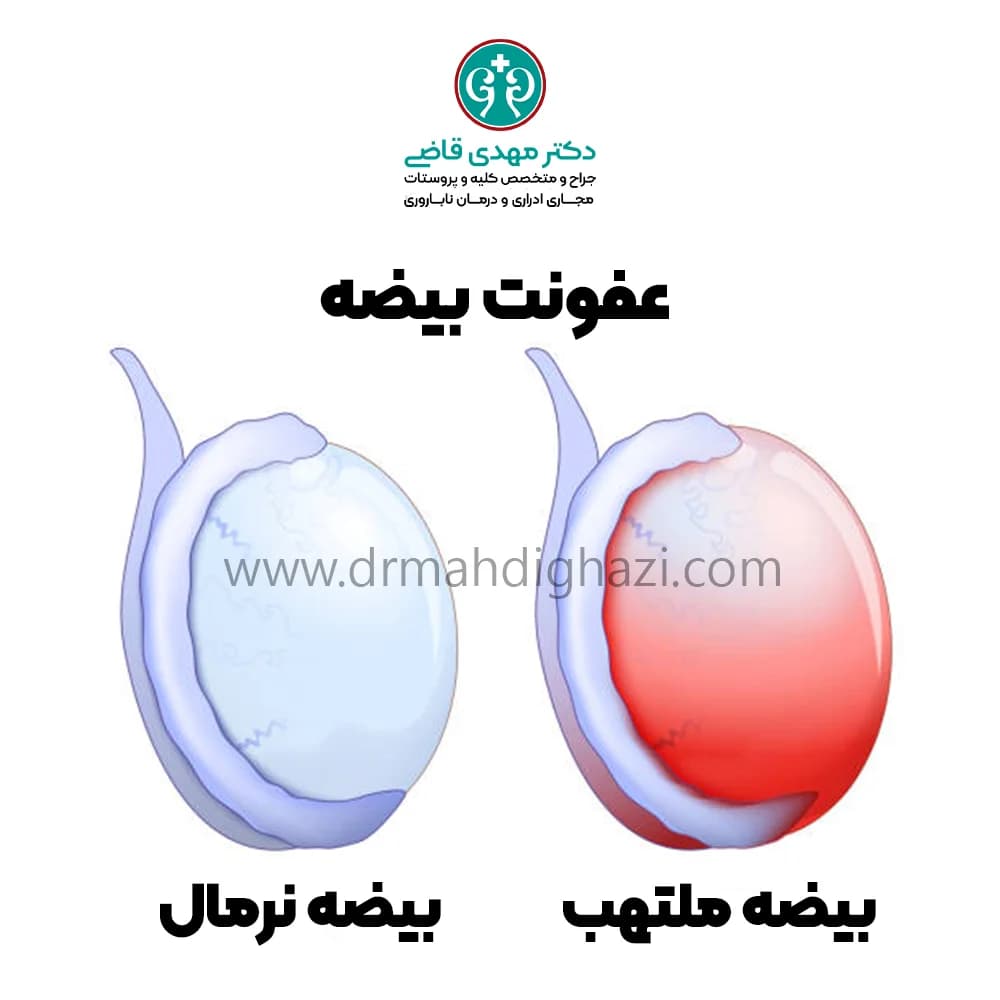 دکتر قاضی- عفونت بیضه