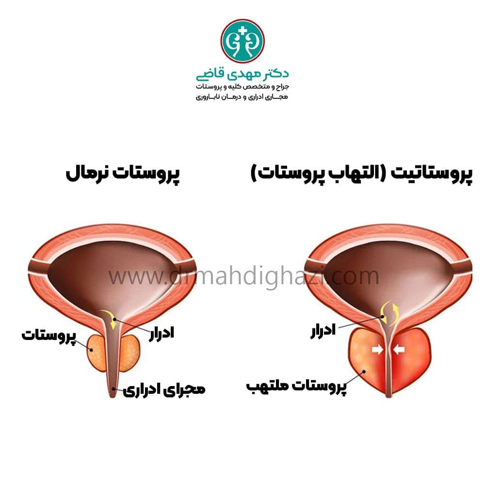 دکتر قاضی-پروستاتیت