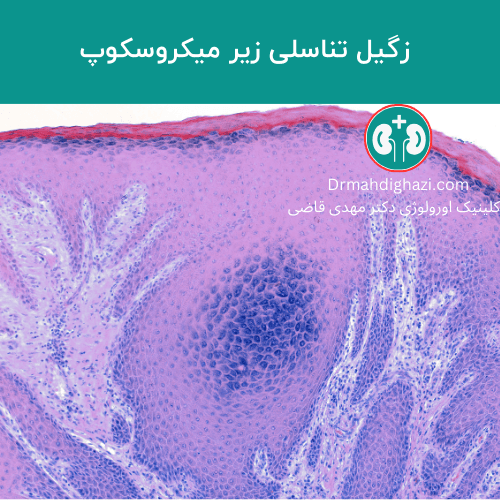 زگیل تناسلی چیست؟ | انواع، علائم و درمان + (تصاویر واقعی!)