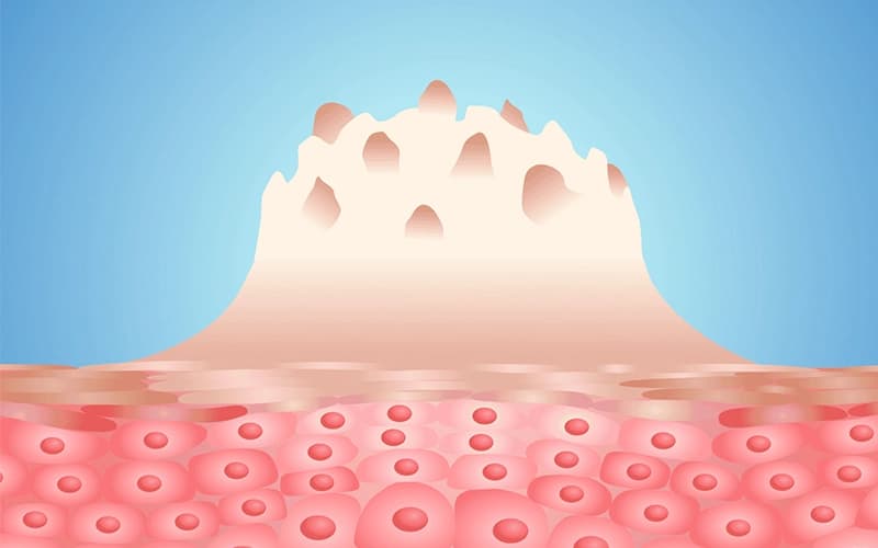 Ways to Prevent Transmission of genital warts