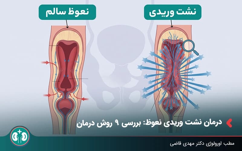 درمان نشت وریدی نعوظ - مقایسه نعوظ سالم با نشت وریدی