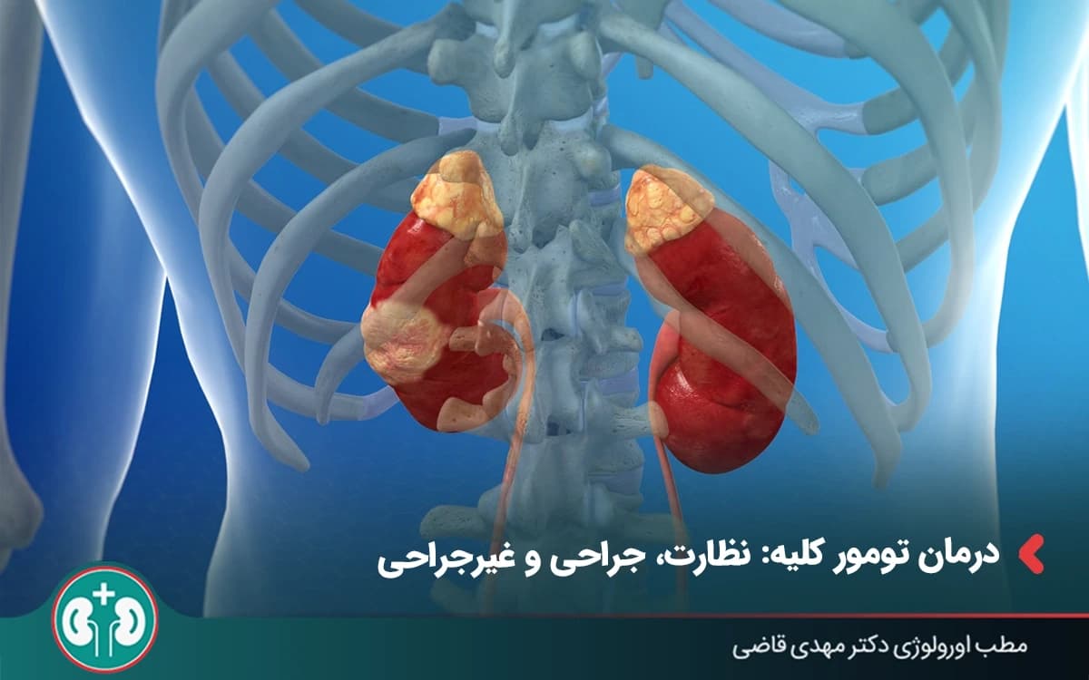 «درمان تومور کلیه» (نظارت، جراحی و غیرجراحی)