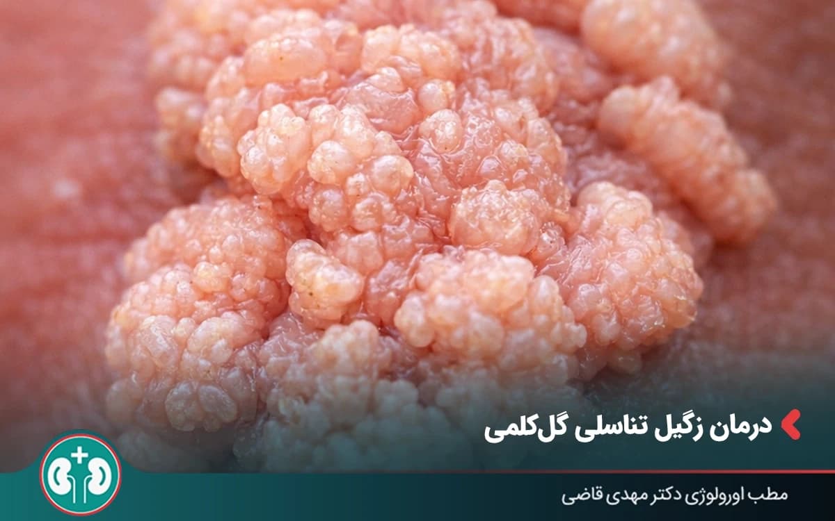درمان زگیل تناسلی گلکلمی و خوشهای | لیزر، فریز، جراحی