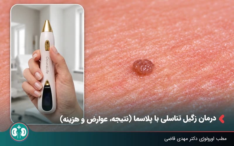 پلاسماتراپی زگیل تناسلی