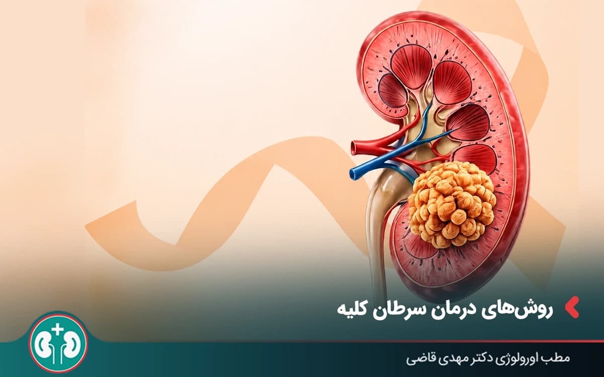 درمان سرطان کلیه؛ روشهای درمان در مراحل مختلف بیماری
