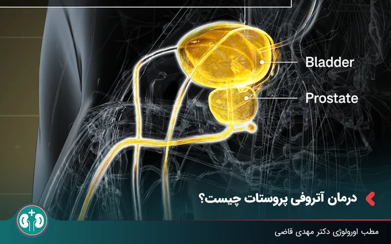 درمان کوچک شدن پروستات؛ آتروفی پروستات چگونه درمان میشود؟