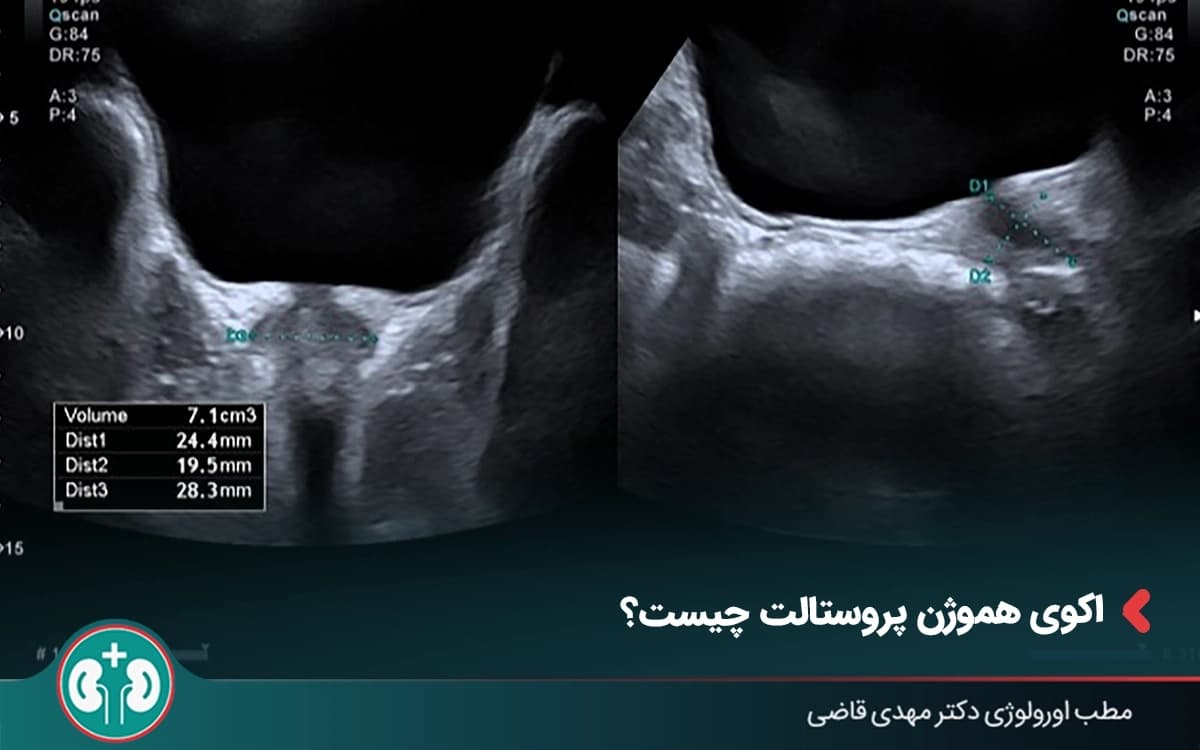 اکوی هموژن پروستات چیست و چگونه تفسیر میشود؟