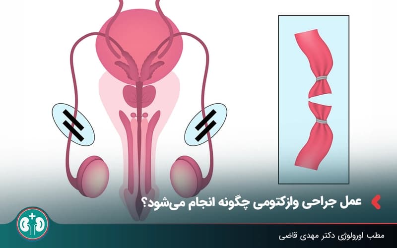 عمل جراحی وازکتومی چگونه انجام میشود؟