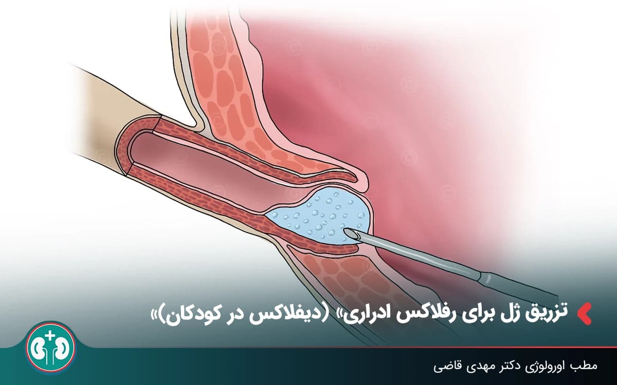 تزریق ژل برای رفلاکس ادراری؛ دیفلاکس برای چه کودکانی مناسب است؟