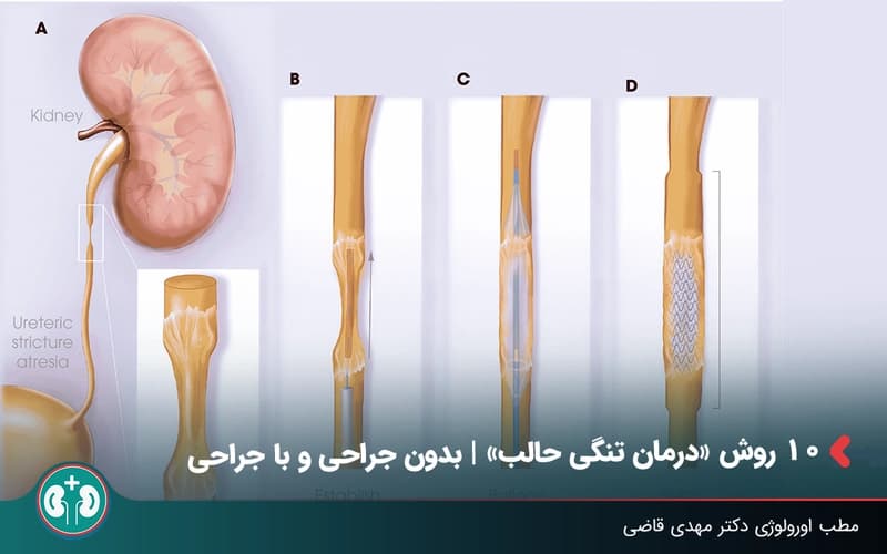روشهای درمان تنگی حالب