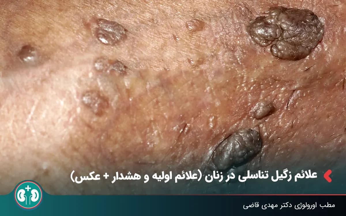 علائم زگیل تناسلی در زنان (علائم اولیه و هشدار + عکس)
