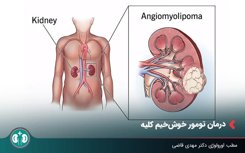 روش های درمان تومور خوشخیم کلیه