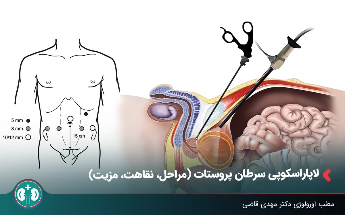 لاپاراسکوپی سرطان پروستات (مراحل، نقاهت، مزیت)
