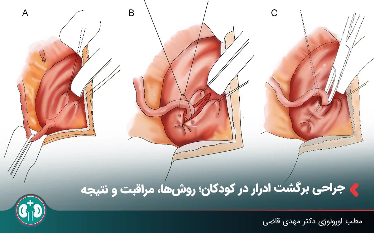 جراحی برگشت ادرار در کودکان (روشها، مراقبت و نتیجه)