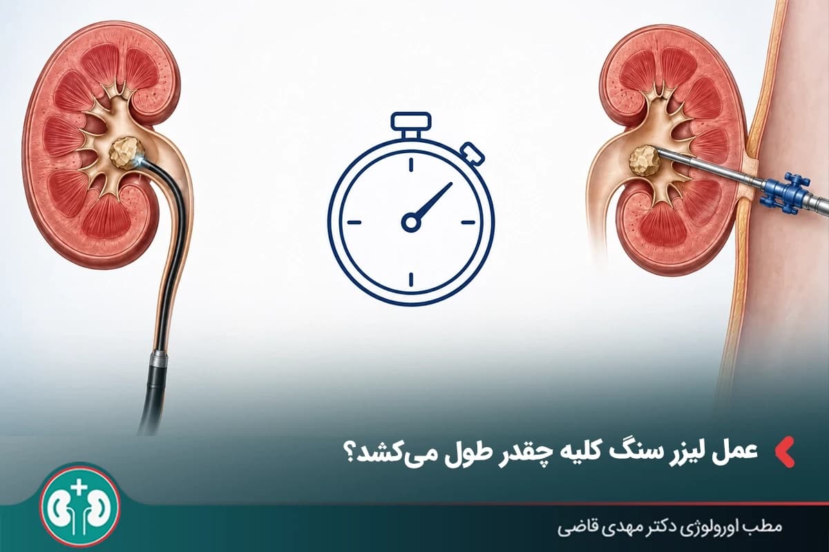 عمل لیزر سنگ کلیه چقدر طول میکشد؟ (مدت عمل PCNL و RIRS)