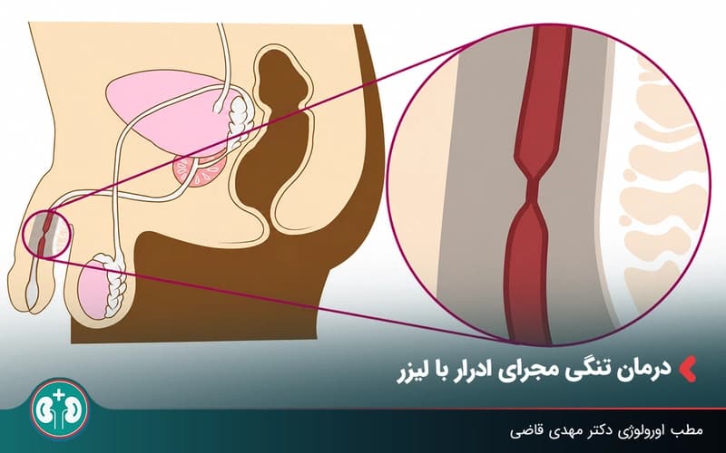 درمان تنگی مجرای ادرار با لیزر