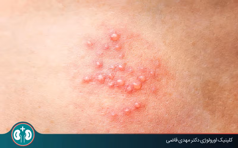 آیا تبخال تناسلی از طریق لباس منتقل میشود؟