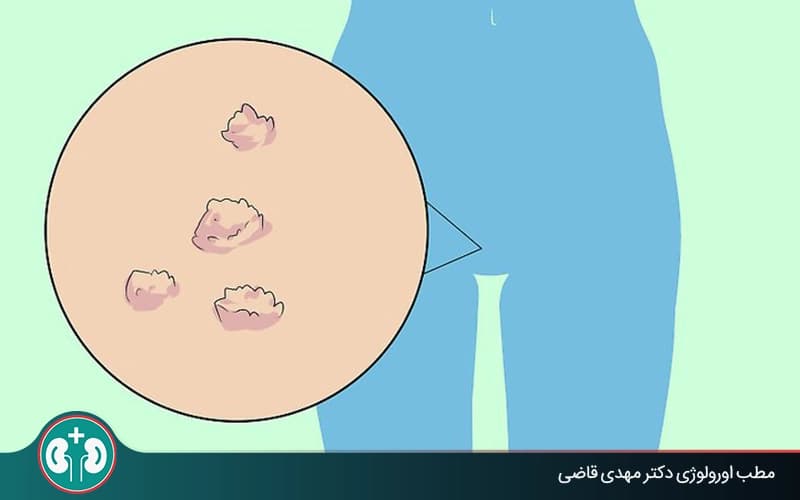 همه چیز دربارهٔ علائم بهبود زگیل تناسلی (HPV) + توصیههای پزشکی