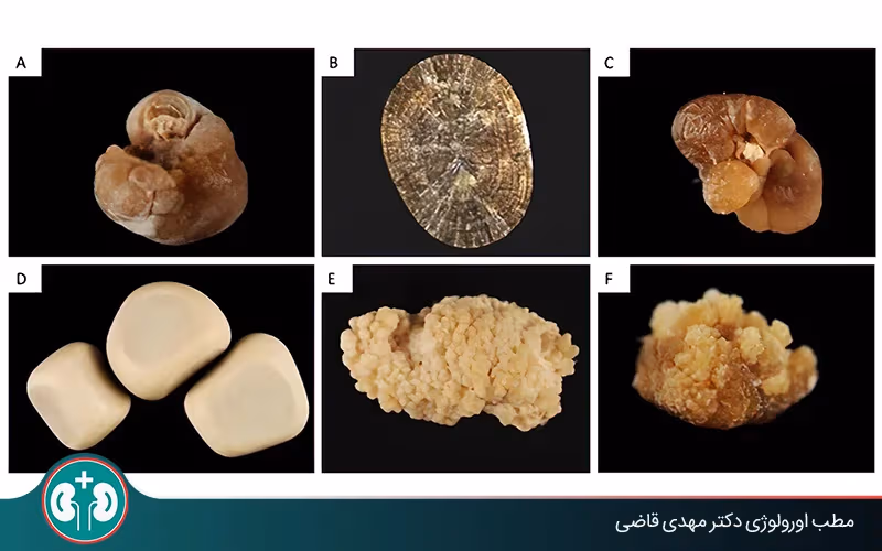 أنواع حصوات الكلى حسب اللون والتركيب والشكل والحجم
