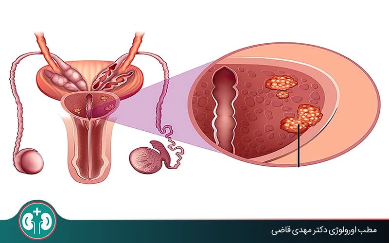 دليل شامل لتحري سرطان البروستاتا: المراحل والنتائج
