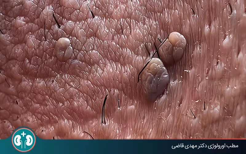 أعراض الثآليل التناسلية عند الرجال: العلامات والتشخيص