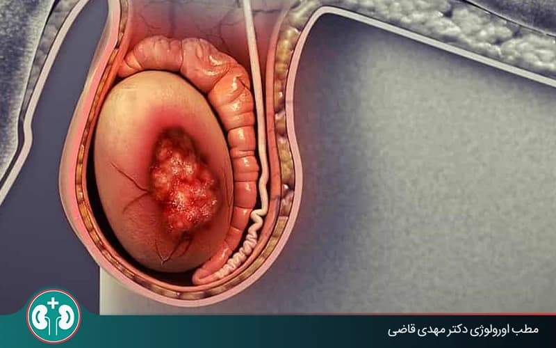 آیا هر تودهای در بیضه نشانه سرطان است؟ | مطب دکتر قاضی