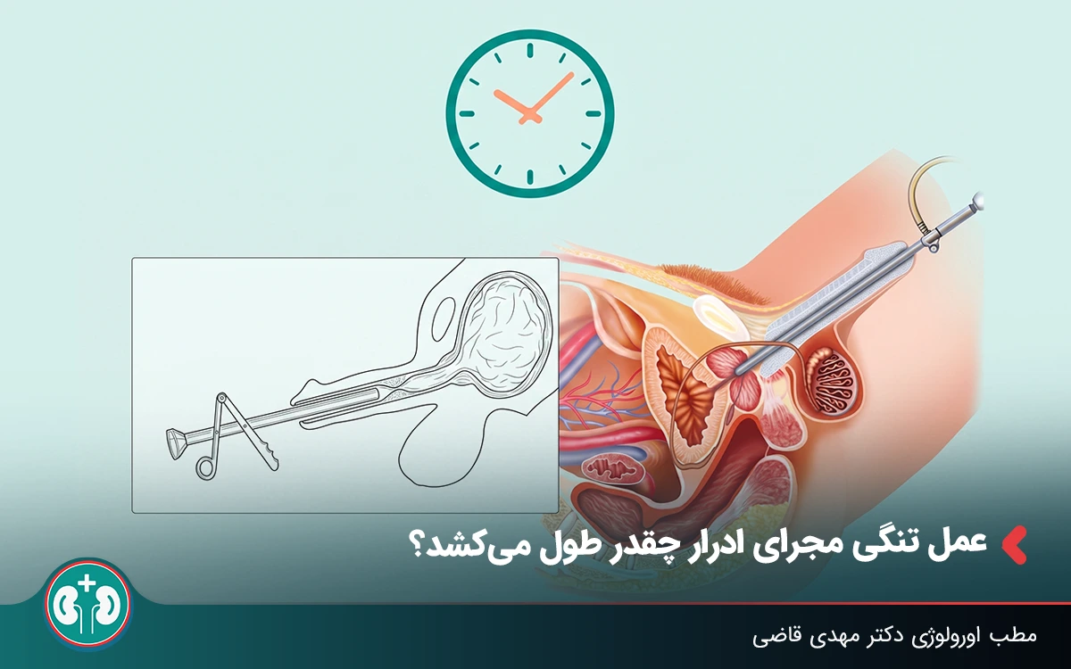 عمل تنگی مجرای ادرار چقدر طول می‌کشد؟