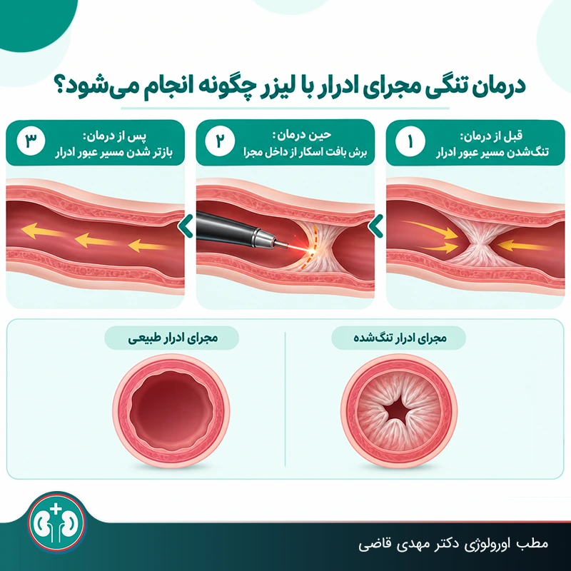 چگونگی باز شدن مجرای ادرار در یورتروتومی با لیزر