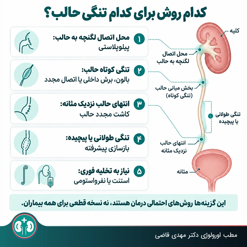 روش مناسب درمان تنگی حالب بر اساس نوع و مکان تنگی